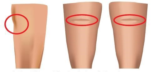 marcas lipoatrofia 1
